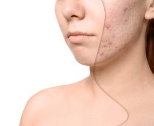 Health Benefits of Tapioca - Removes acne